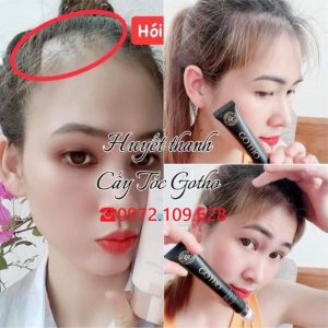 Review Lăn cấy tóc GOtho Huyền Phi