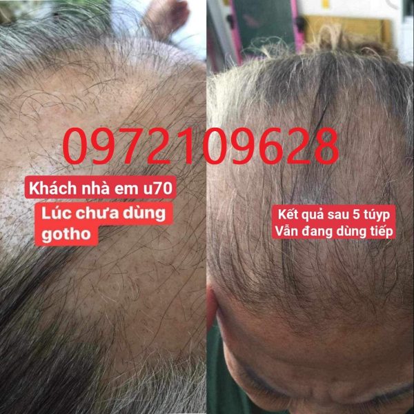 Rụng hơn 20 năm vẫn mọc nhờ Cấy tóc gotho Huyền Phi