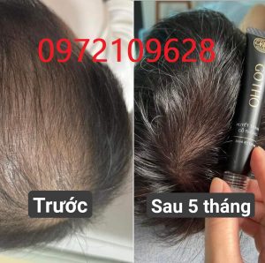 Review cấy tóc Huyền Phi hết rụng hết hói