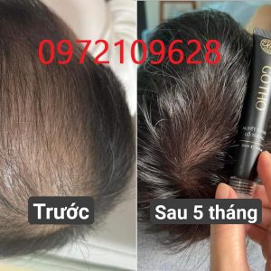 Review cấy tóc Huyền Phi hết rụng hết hói