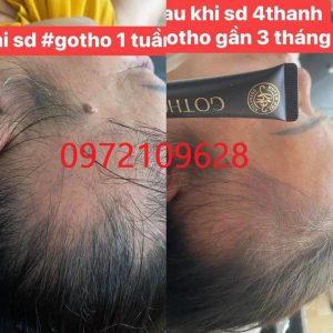 Người già rụng tóc lâu năm - Cấy tóc gotho Huyền Phi