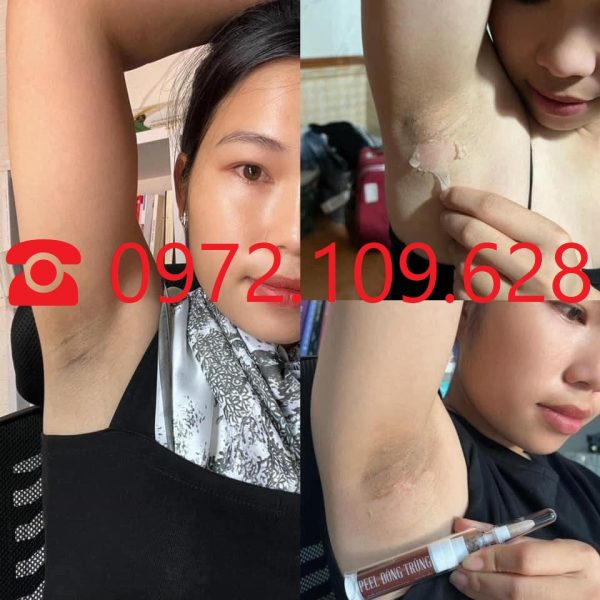 Peel nách bằng peel đông trùng tươi Huyền Phi